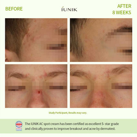 Iunik Centella Calming AC Spot Cream tulokset ennen ja jälkeen